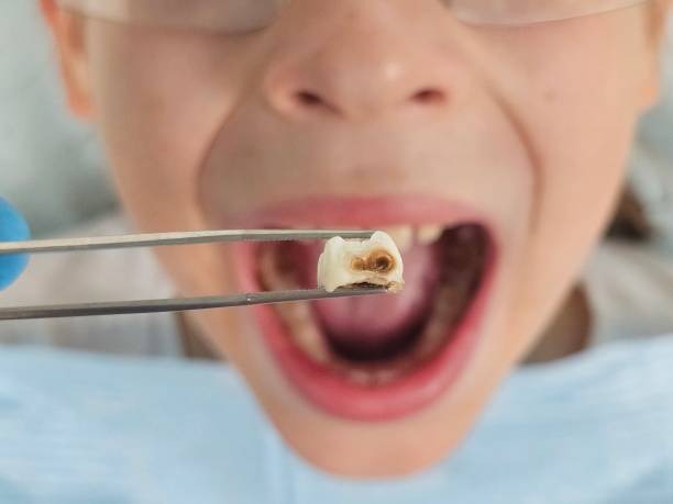 Best Emergency Dental Extractions in Quitman, TX